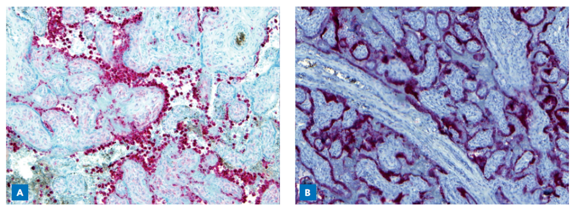Imunohistochemické vyšetření placenty. Histiocytární (CD68-pozitivní, červené barvení) intervillositis, klky se barví modře
(A). Silně pozitivní přítomnost SARS-CoV-2 (monoklonální protilátka proti SARS2-Bio-SB, červené barvení), koronavirus primárně
lokalizován v oblasti syncytiotrofoblastu (B).