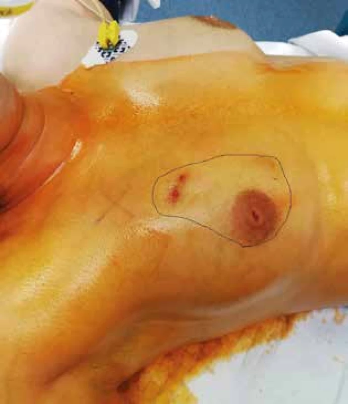 Předoperační označení rozsahu resekce prsu s GM <br>
Fig. 1: Preoperative marking for breast resection due to GM