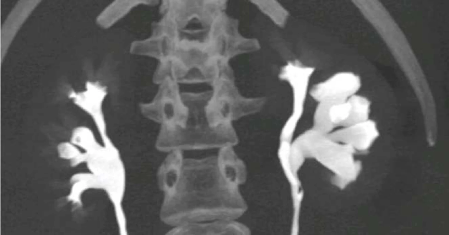 CT-IVU, dilatace dolního segmentu levé ledviny<br>
Fig. 1. CT-IVU, dilatation of the
lower segment of the left kidney