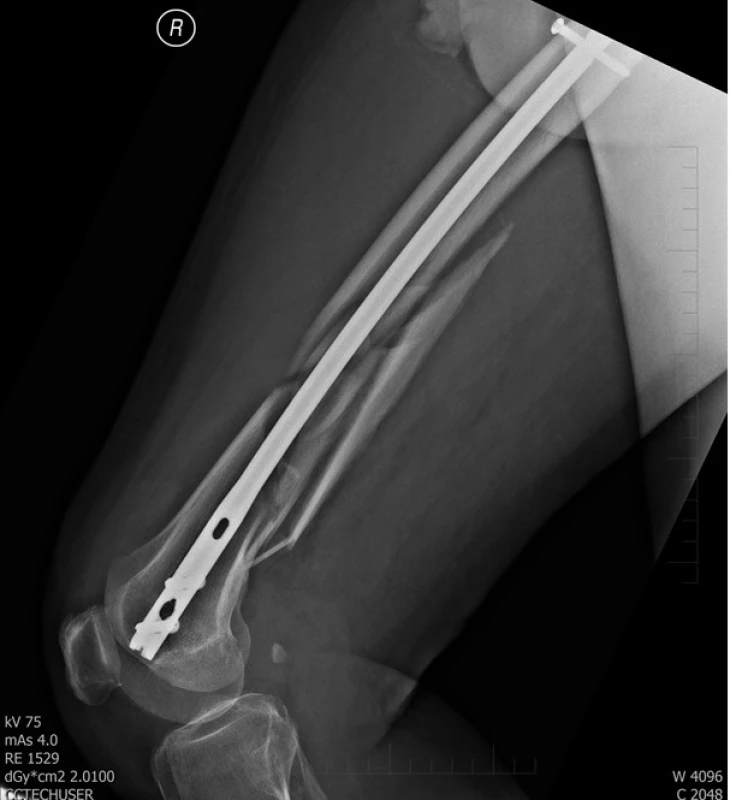 Pooperační rtg stehenní kosti vpravo
– stav po nitrodřeňové osteosyntéze femuru