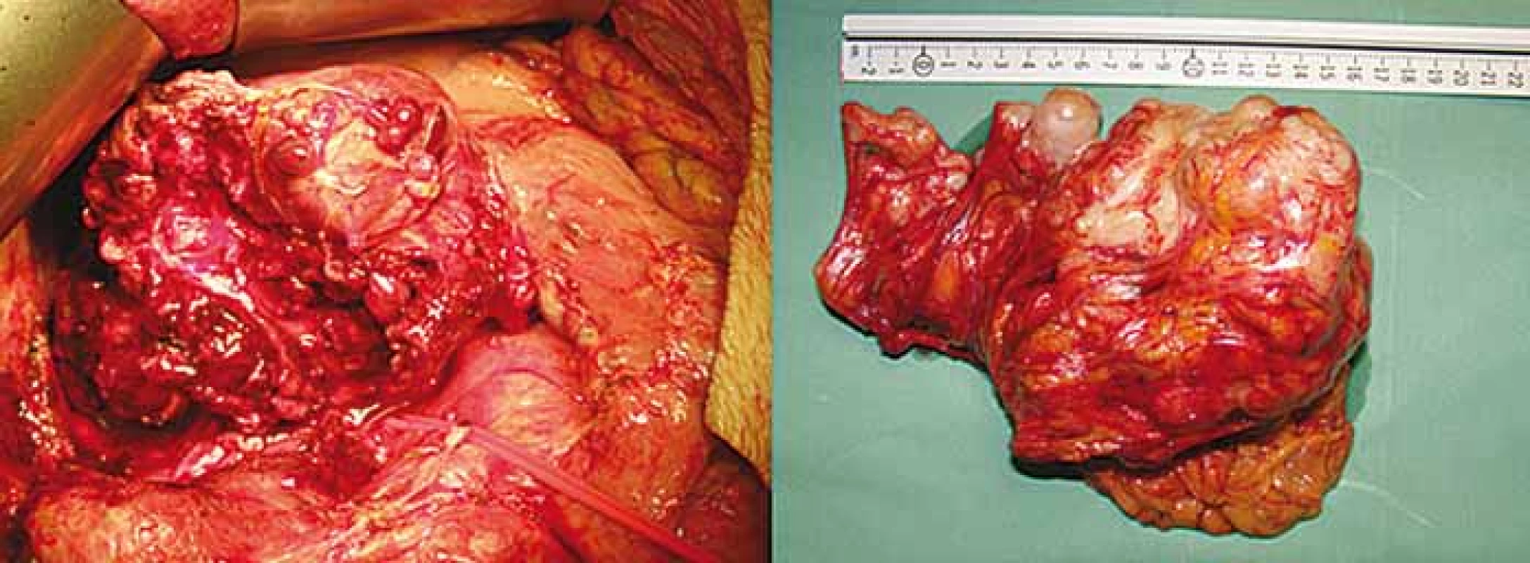 A. Intraoperative photo showing gastrointestinal stromal tumor and diaphragmatic
crus. 3B. Specimen after proximal gastrectomy showing “en-block” tumor and
esophago-gastric junction.