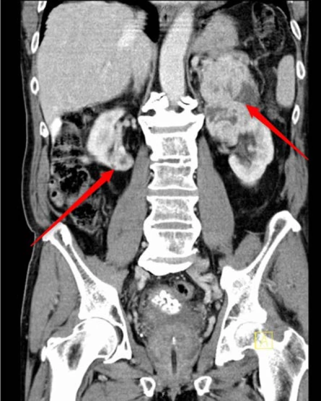 Kontrastní CT vyšetření břicha a malé pánve
– bilaterální synchronní tumor ledviny (viz šipky),
benigní hyperplazie prostaty, mnohočetná cystolitiáza<br>
Fig. 1. Contrast CT scan – bilateral synchronous
renal cell carcinoma (see arrows), benign prostatic
hyperplasia, multiple bladder stones