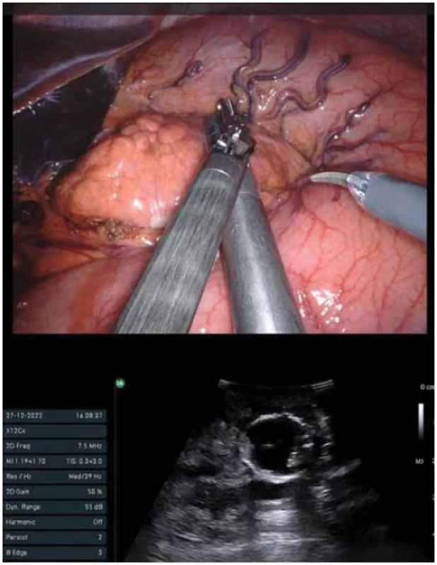 Perioperační ultrasonografi e zobrazující ložisko NET v těle pankreatu – nahrazuje
absenci palpačního vjemu při robotické operaci. <br> 
Fig. 3. Perioperative ultrasonography showing the NET deposit in the body of the pancreas
– replaces the absence of palpation during robotic surgery.