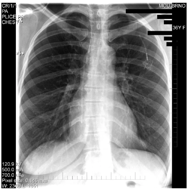 RTG hrudníku – Obraz kompletní ruptury katetru
portu (pinch-off)<br>
Fig. 4. Chest X-rays – Complete rupture of the port catheter
(pinch-off)