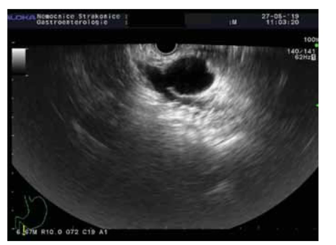 BD-IPMN.<br>
Fig. 2. BD-IPMN.