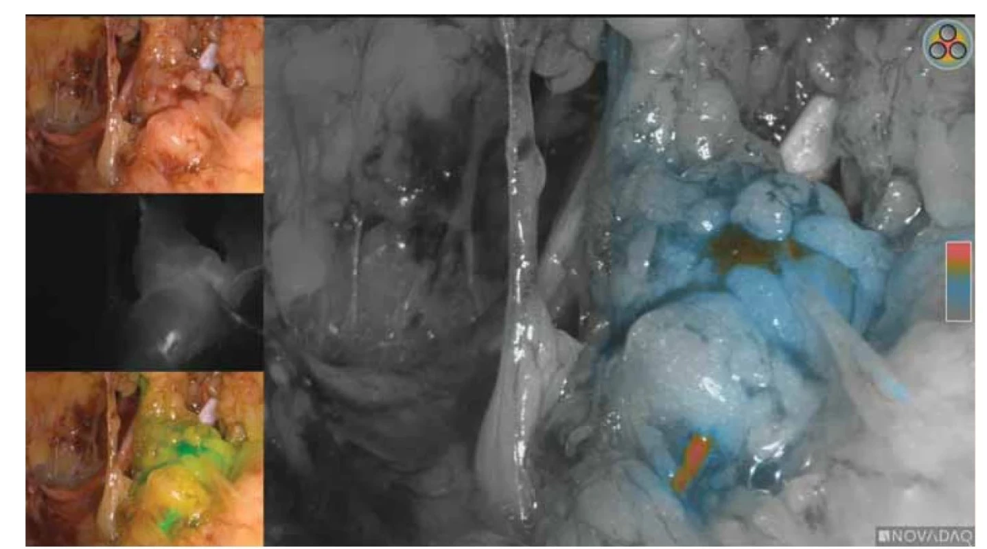 Sentinelová lymfatická uzlina v supraobturátorové oblasti – Novadaq Pinpoint CSF Mode.<br>
Fig. 3. Sentinel lymph nodes in the supraobturator region – Novadaq Pinpoint CSF Mode.