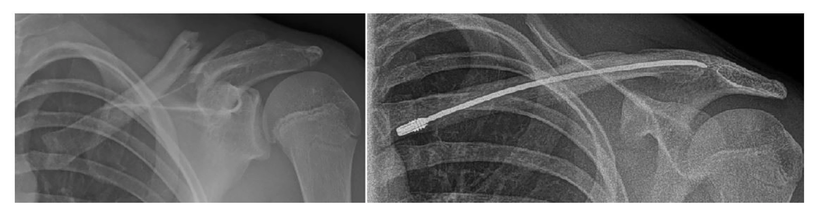 Nitrodřeňová stabilizace klíční kosti<br>
Fig. 2: Clavicle intramedullary nail fixation