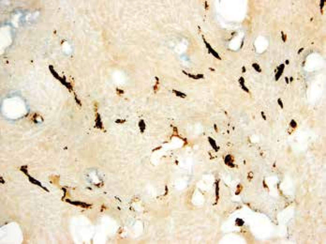 Epitelové struktury v nekrotickém punkčním vzorku z jater (Imunohistochemická reakce s CK 7, původní zvětšení 200x).