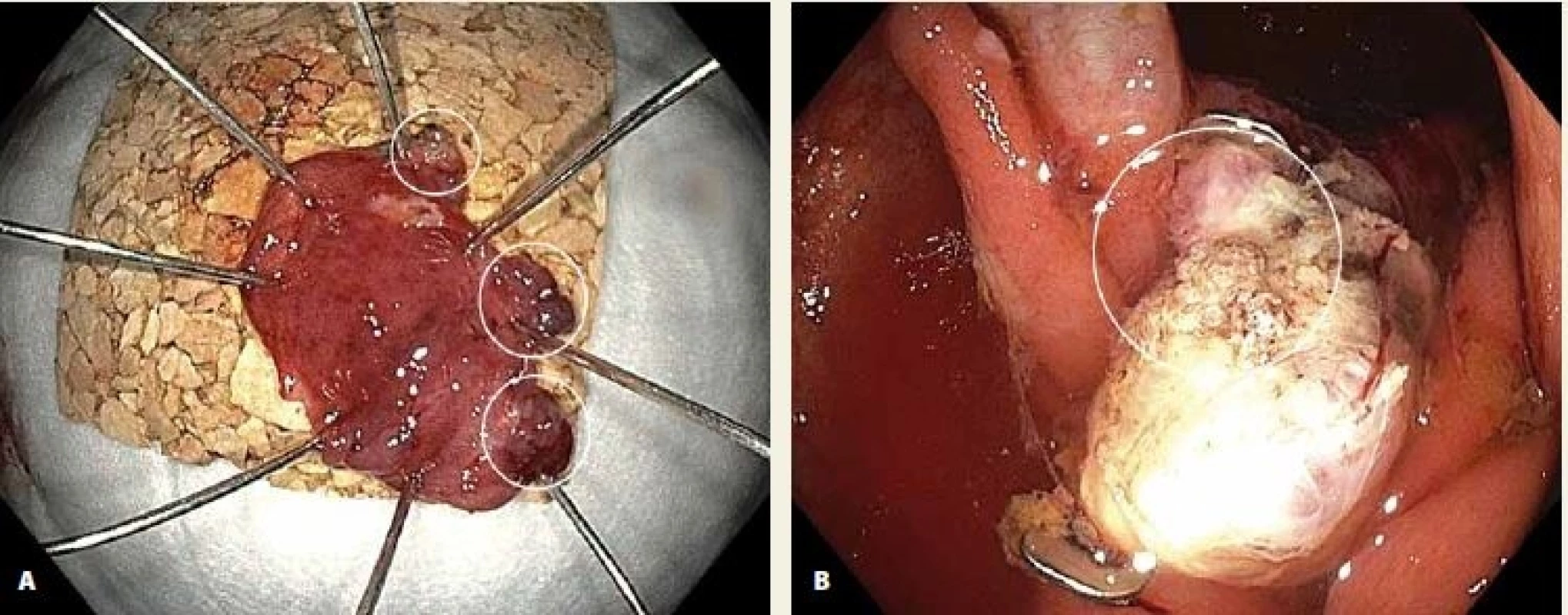 A. Resekát na korkové podložce po inkompletní resekci LRN ascendens, fragmenty neoplazie jsou patrné v okraji resekátu; B. místo resekce s drobným reziduem LRN nad naloženým OTS klipem. Fig. 3. A. Specimen on a cork board after an incomplete resection of LRN in the ascending colon, fragments of neoplastic tissue evident at the resection margins; B. residual neoplastic tissue above the OTS clip.