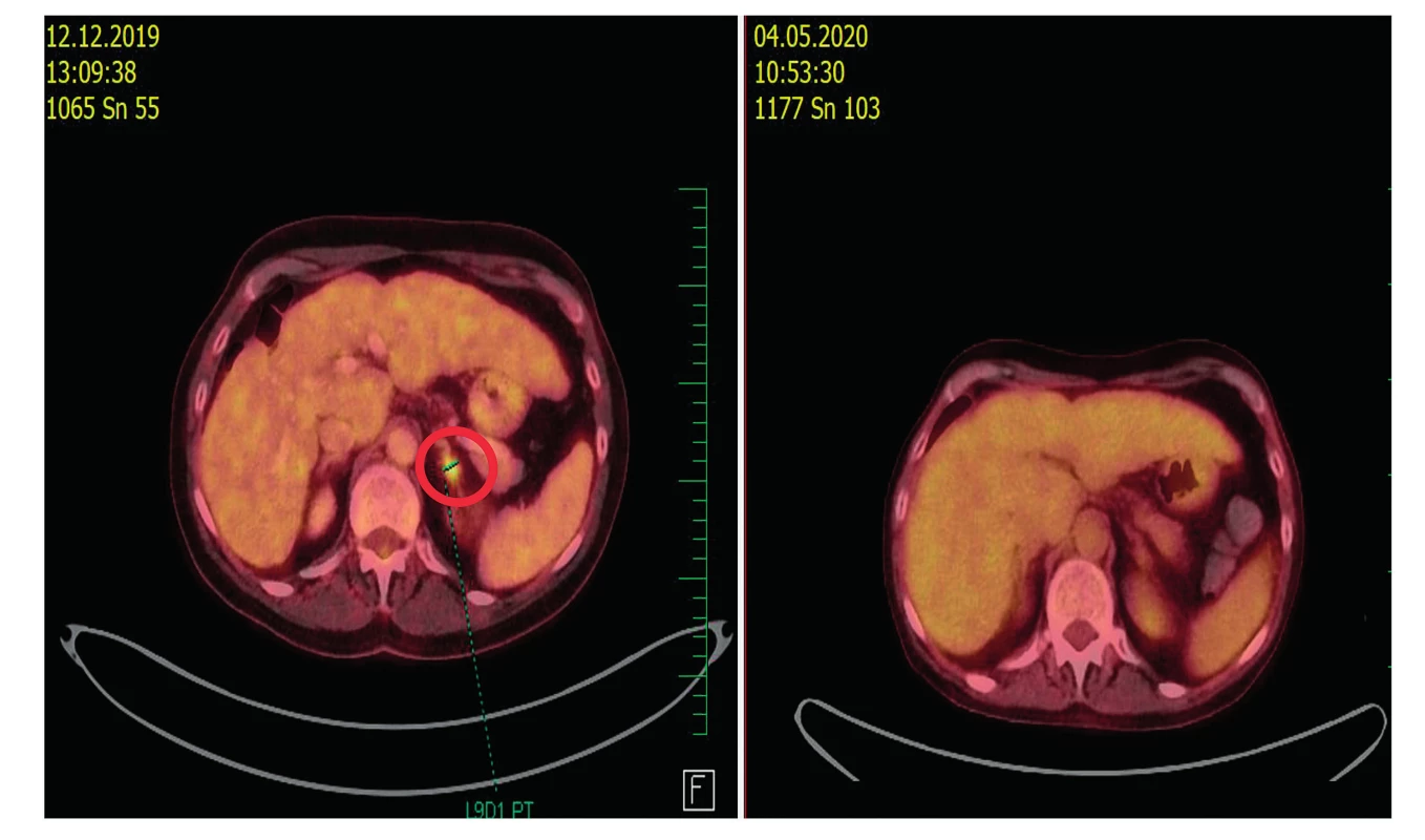 PET/CT. Regrese metastázy v levé nadledvině