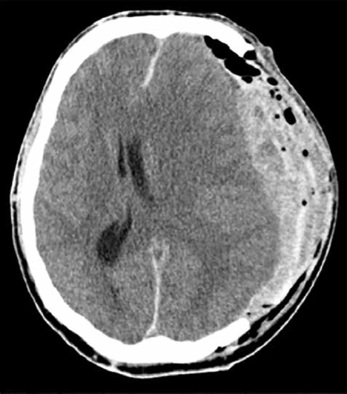 Pooperační subgaleální/subdurální hematom<br>
Fig. 1: Postoperative subgaleal/subdural haematoma