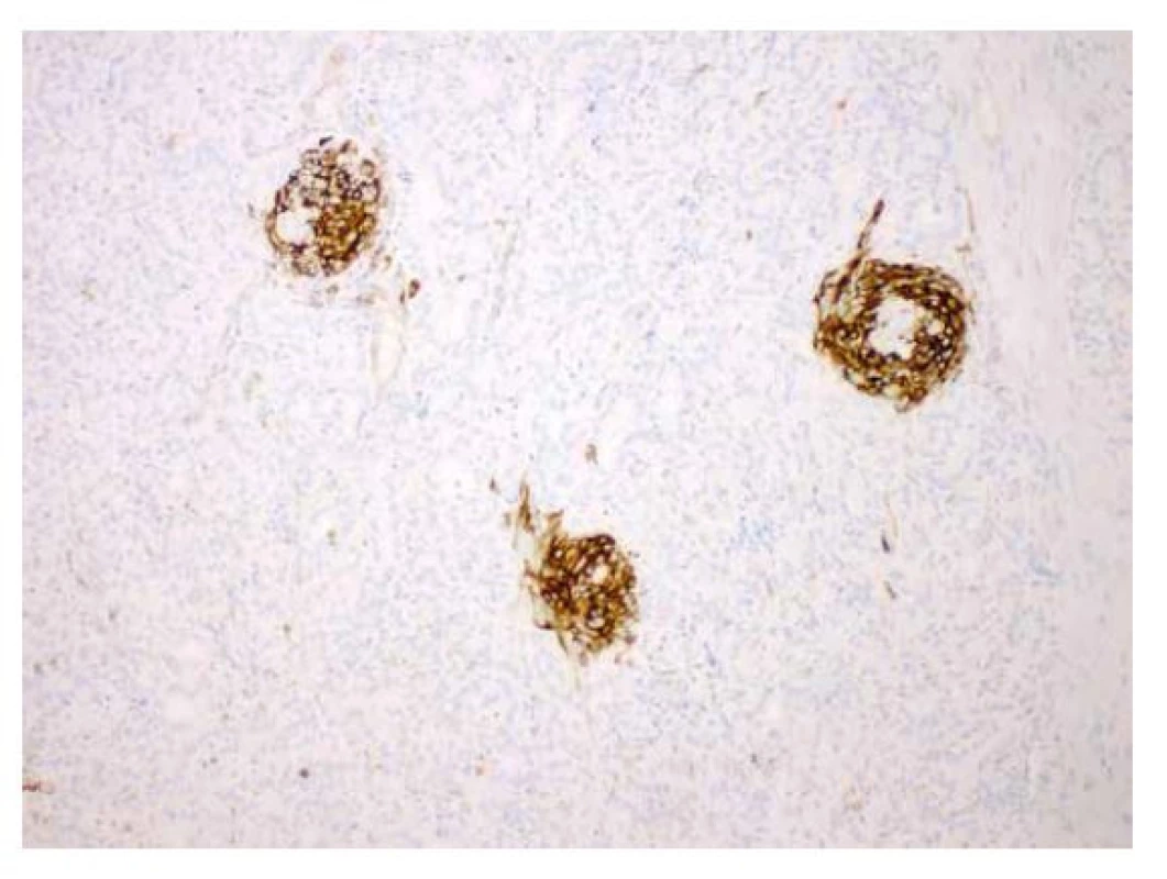 Imunohistochemický průkaz HBME1 v morulárních formacích (zvětšení
100x).