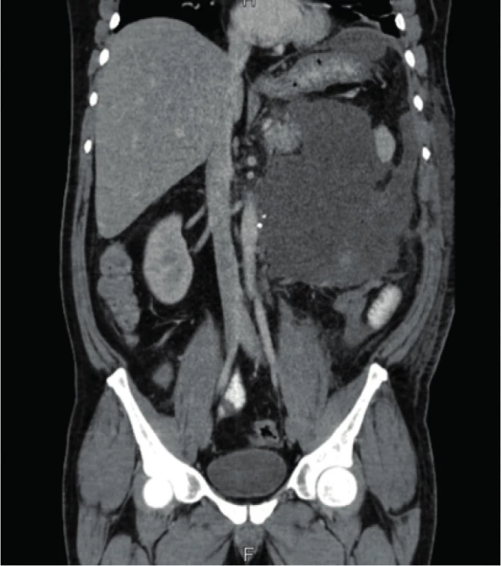 CT nález peripankreatické tekutinové kolekce
pooperačně<br>
Fig. 2. CT finding of the peripancreatic fluid collection after surgery