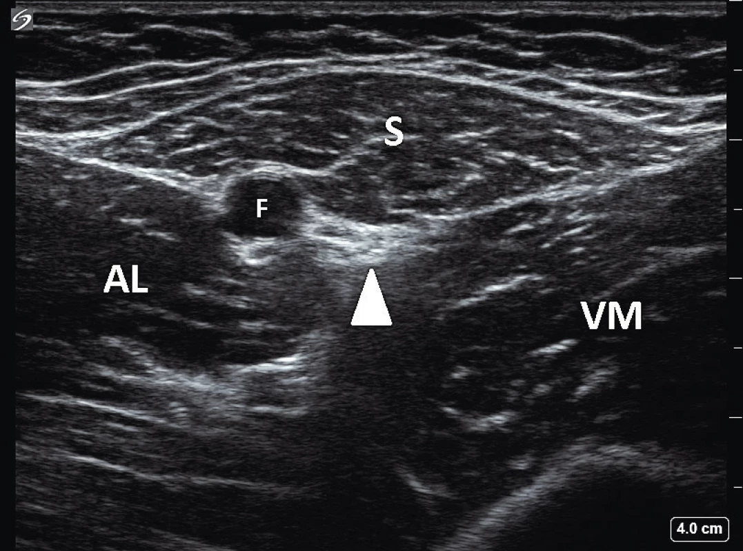 Ultrazvukový obraz stehna LDK v oblasti femorálního
trojúhelníku: S – m. sartorius, AL – m. adductor longus, VM – m.
vastus medialis, F – femorální tepna, bílý trojúhelník označuje
interfasciální prostor, ve kterém jsou nervus saphenus a nervus
vastus medialis