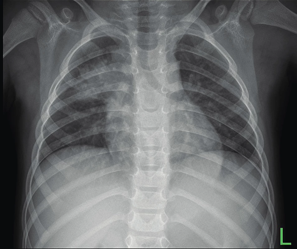 a. Polyrezistentní tuberkulóza u tříletého chlapce. SKG
hrudníku před léčbou.<br>
Fig. 1a. Three years old boy with polyresistant TB. Chest X-ray
before therapy.