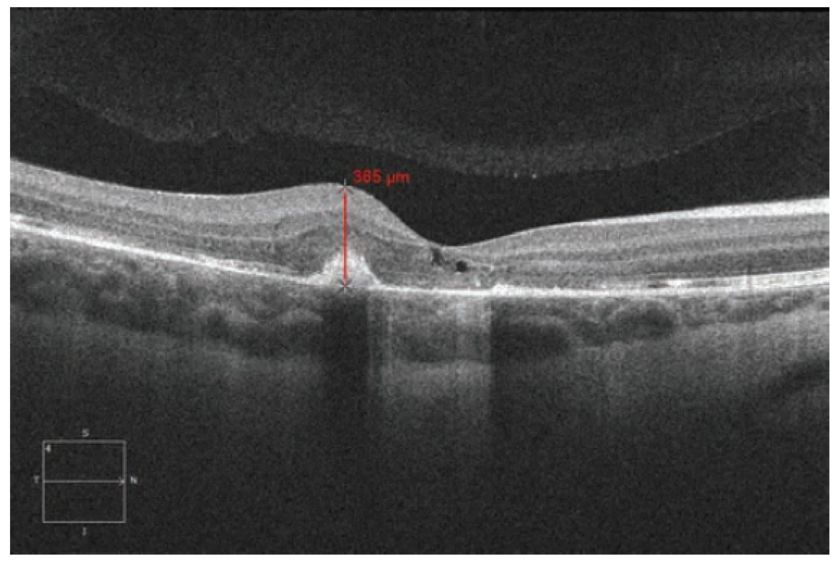 Spectral HD OCT Linear horizontal macular scan after 3 intravitreal
injections of ranibizumab (Lucentis) at monthly intervals
with significant regression of macular thickness and volume. Regression
of macular thickness of juxtafoveolar area from 680 μm to
365 μm