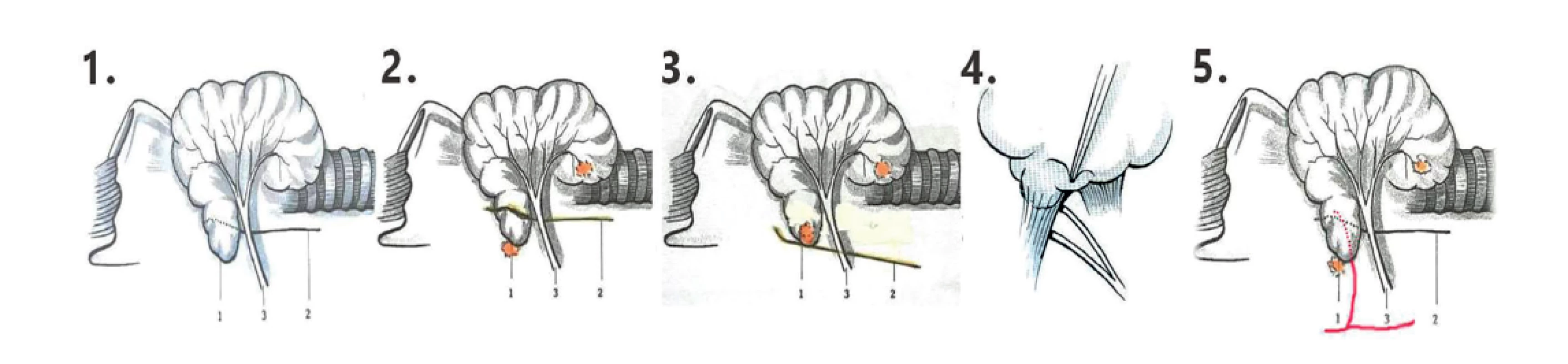 Vztah NLR a TZ – varianty průběhu NLR<br>
Fig. 4: The relationship between NLR and TZ – various courses of the NLR