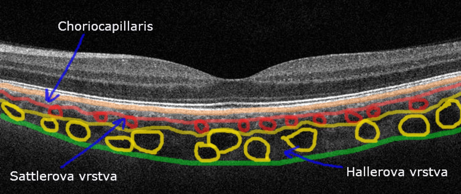 The anatomy of the choroid. Layers of choriocapilaris, Sattler's and Haller's layers are marked with arrows.