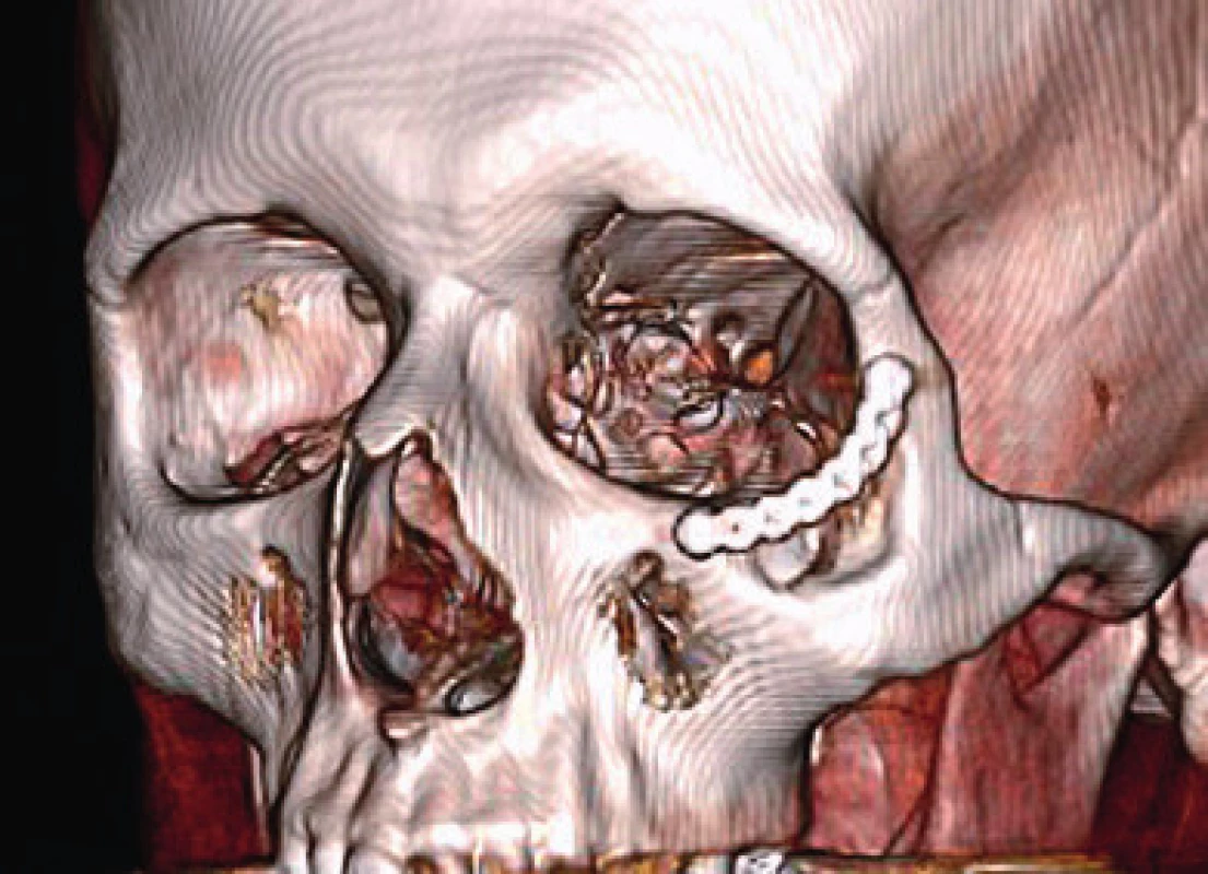 Three-dimensional CT scan after 5 months from the
surgery. The postoperative defect of the zygoma bridged with the
titanium miniplate is visible in the scan
