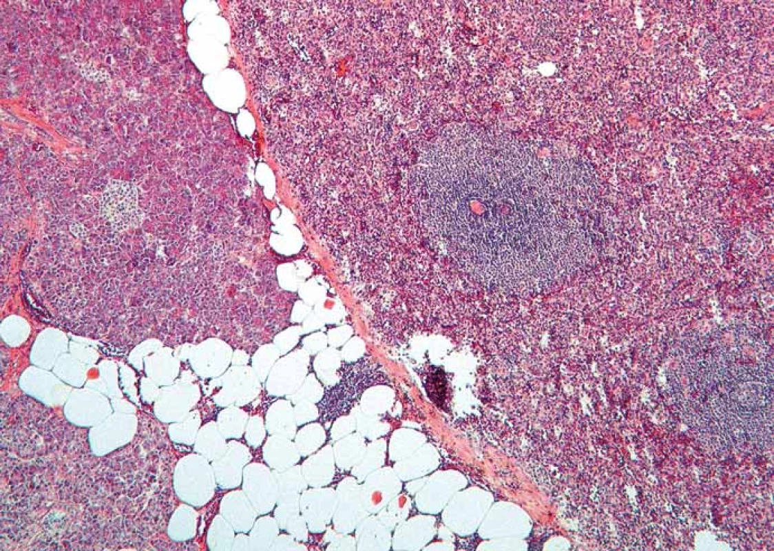 Histologický nález – intrapankreatická akcesorní slezina (IPAS) oddělená
od pankreatické tkáně vazivovým pouzdrem (barvení hematoxylin-eozinem,
zvětšení 50×).
Fig. 1. Histopathological image – intrapancreatic accessory spleen (IPAS) separated
by a fibrous capsule from the pancreatic tissue (Haematoxylin and eosin staining,
magnifi cation 50×).