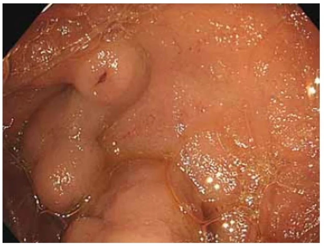Defekt na povrchu duodenálního varixu. <br> 
Fig. 1. Defect on the surface of the duodenal varix.