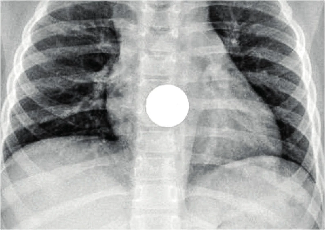 Mince v jícnu. <br><b>Fig. 4.</b> Coin in the esophagus.
