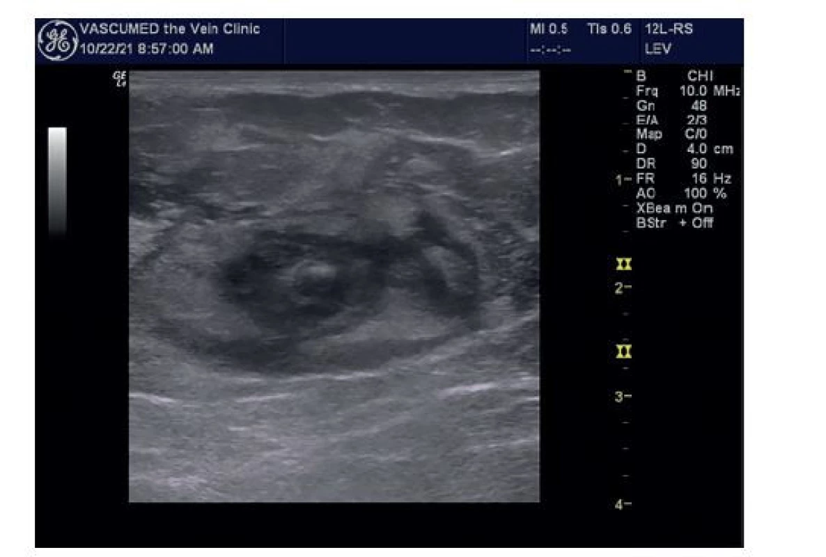 Safénová fascie vyplněná tumescentním roztokem
(„safénové oko“)<br>
Fig. 3: Saphenous fascia filled with the tumescent solution
(„saphenous eye“)