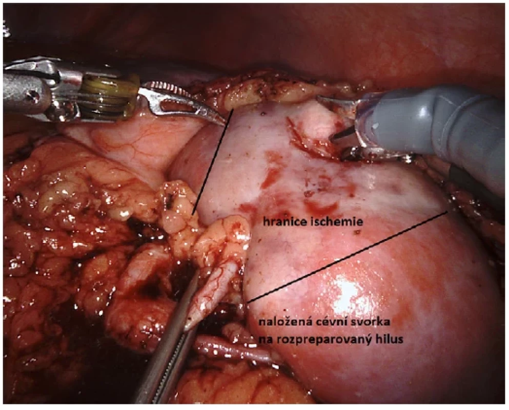Stav po naložení cévní svorky a patrné hranice ischemie <br> 
Fig. 4. Condition after application of the vessel clamp and visible ischemia boundaries