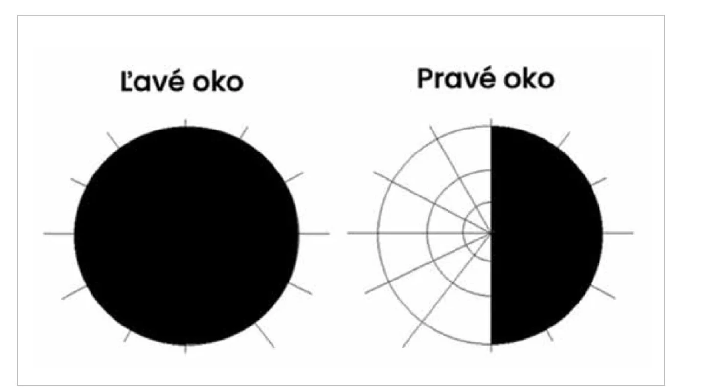 Model zorného poľa pacientky – na pravom oku nález temporálnej hemianopsie a na ľavom
oku úplná anopsia