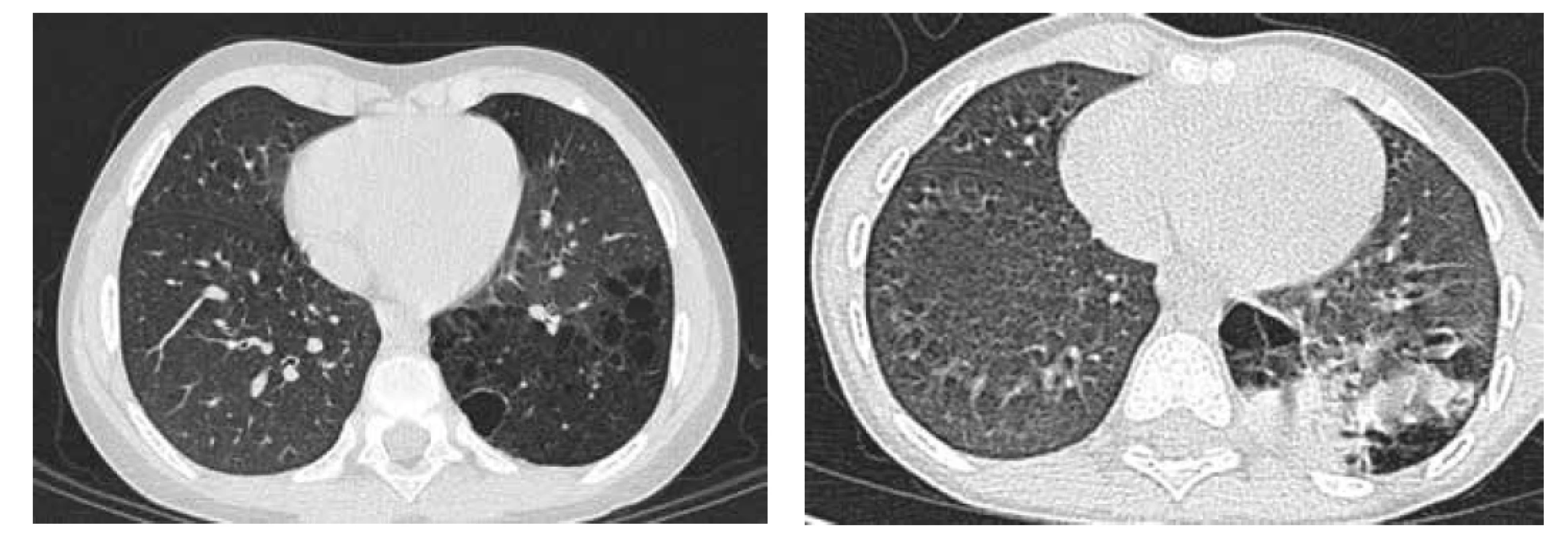 A. CT hrudníku, transverzální řez, CPAM typu 1 v LDL.<br>
Fig. 4A. Chest CT scan, transversal cut, CPAM type 1 in left lower lobe.<br>
Obr. 4B. CT hrudníku, transverzální řez, pneumonie LDL v CPAM.<br>
Fig. 4B. Chest CT scan, transversal cut, pneumonia in CPAM in left lower lobe.