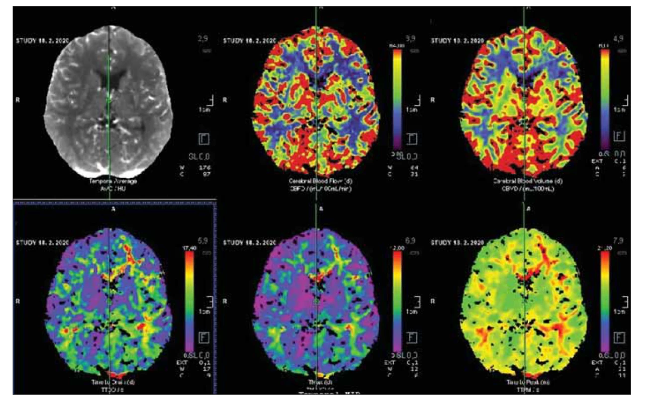 Bazální CT perfuze po revaskularizaci s úpravou všech parametrů. Následná zátěžová CT perfuze potvrdila úpravu cerebrovaskulární
reaktivity.<br>
Fig. 9. Basal CT perfusion after revascularization with restoration of all parameters. Challenging perfusion CT proved restoration of cerebrovascular
reactivity.
