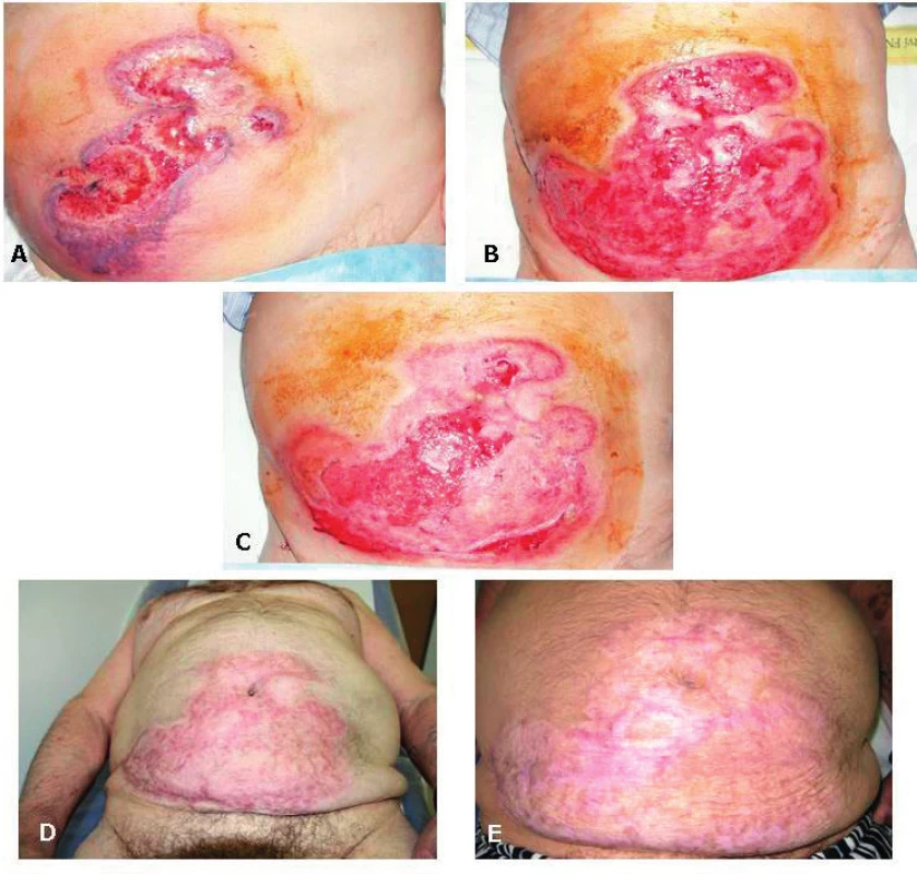 Ulcerózní forma pyoderma gangrenosum na přední
stěně břišní v časové řadě