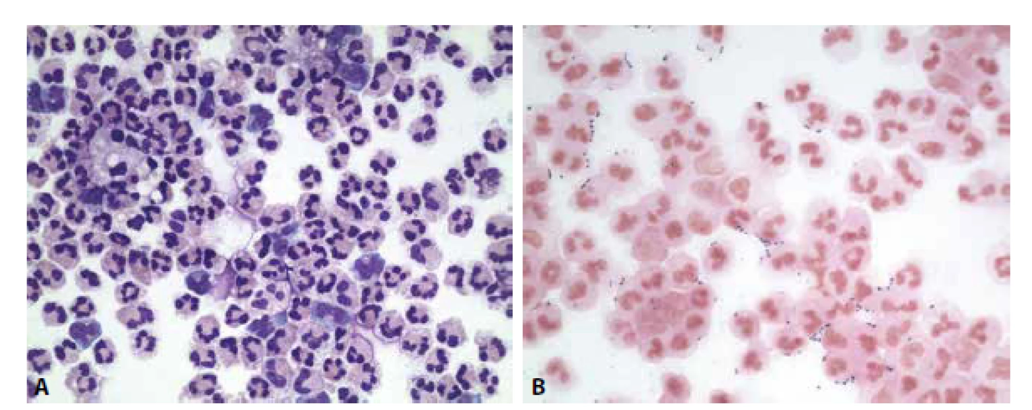 Ilustrační případ 1. Hnisavá meningitis. (A) Neutrofilně granulocytární pleocytóza. MGG, 400x. (B) Extra- i intracelulární přítomnost
diplokoků. Gram. 400x.