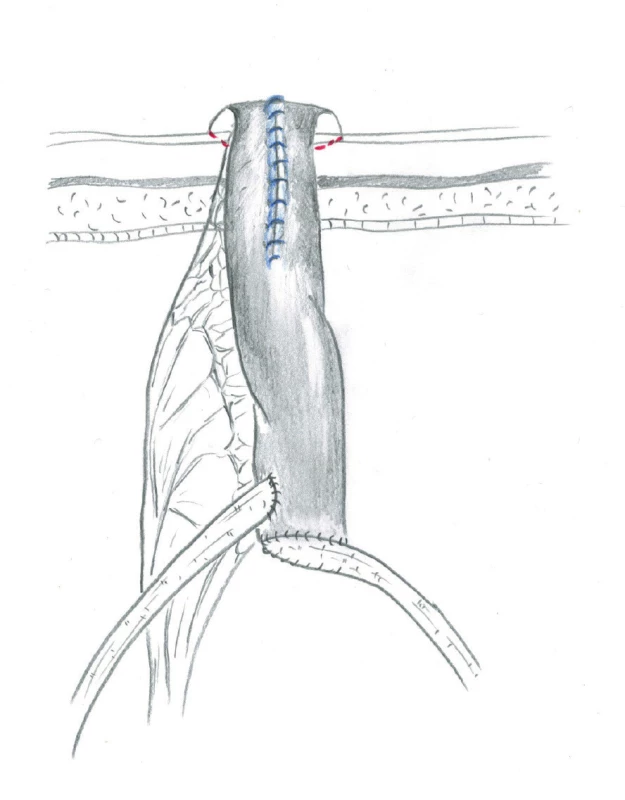 Retubularizovaná část neoveziky je využita
k vytvoření stomie<br>
Fig. 5. The retubularized part of neobladder is used for
the creation of stoma