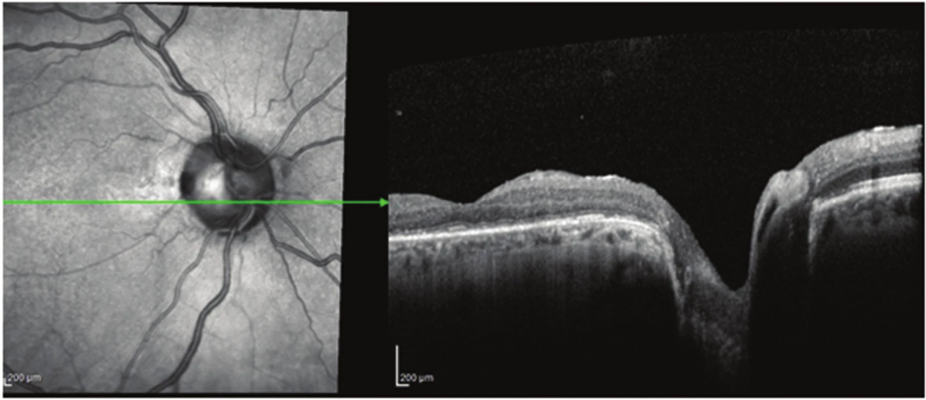 Patient no. 6 Linear horizontal transfoveolar OCT scan of RE after PPV, renewal of foveolar depression
