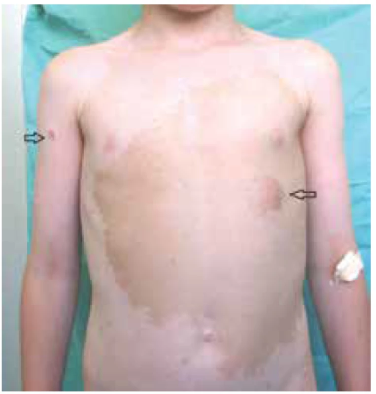 Plexiformní neurofibrom<br>
Zdroj: Pediatrická klinika LF MU a FN Brno