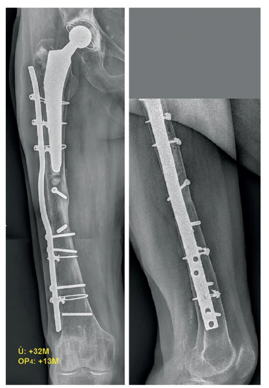 RTG 13 měsíců po aplikaci předehnuté dlahy – definitivní
zhojení<br>
Fig. 10: X-ray showing a successfully healed nonunion 13 months after
implantation of the wave plate