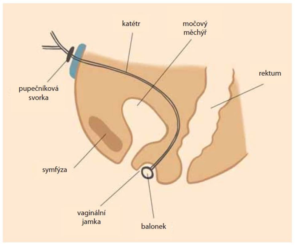 Laparoskopicky asistovaná balonková vaginoplastika.<br>
Fig. 1. Laparoscopically assisted balloon vaginoplasty.