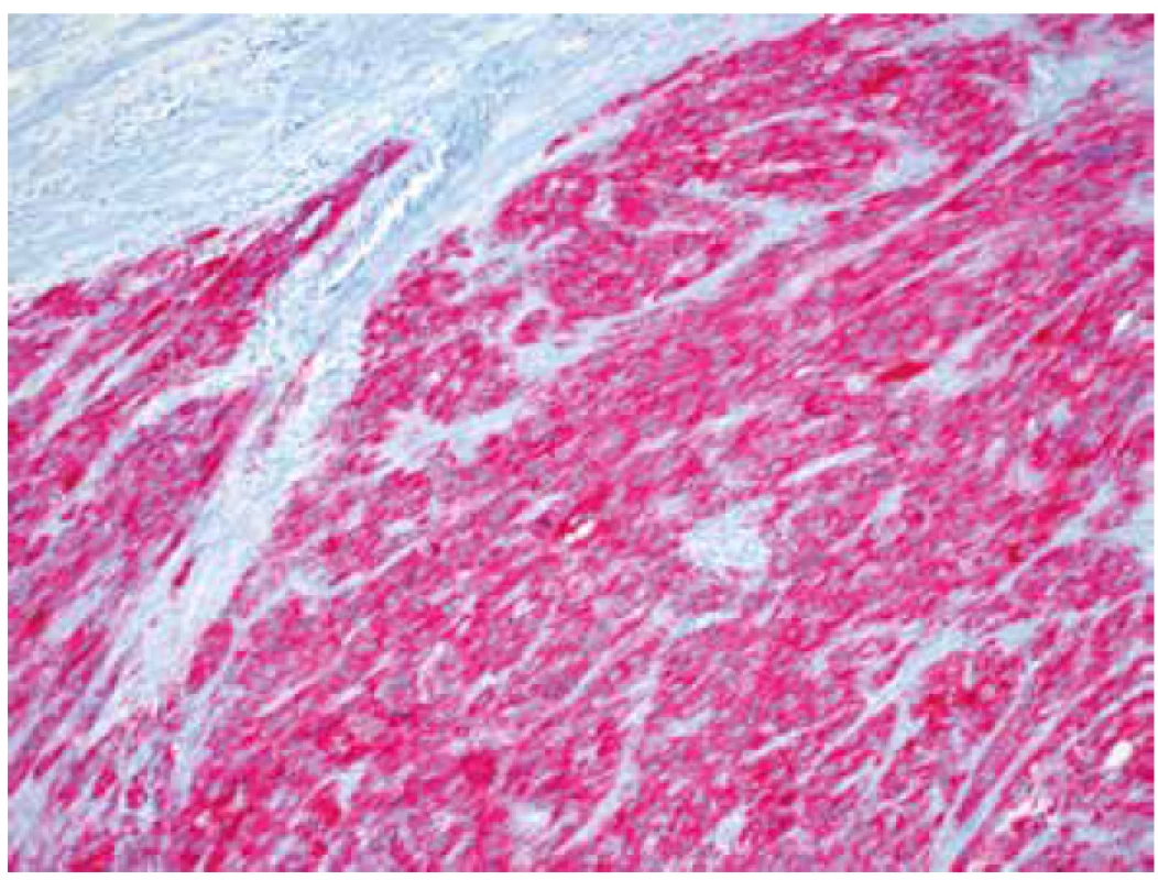 Silná difúzní cytoplasmatická pozitivita ALK (IHC, 200x).