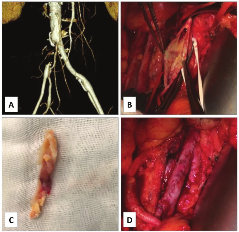 Endarterectomy of isolated occlusion of common
iliac artery, case 6