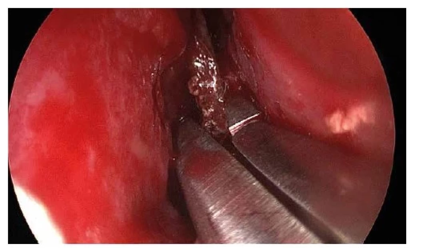 Obrázek z endoskopu (Storz, Německo, 30° optika)<br>
Extrakce cizí předmětu klíšťkami z levého nosního průduchu.<br>
Fig. 2: Endoscope image (Storz, Germany, 30 degree scope)<br>
Extraction of the foreign object from the left nasal cavity
using forceps.