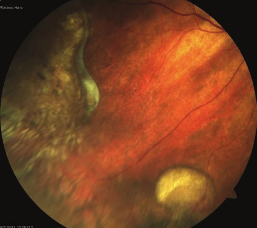 Atrophic lesion with fibrosis in RE