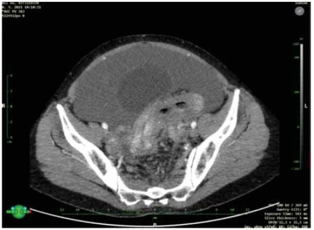 The CT scan surprisingly showed massive ascites in the abdominal cavity with
highly suspected tumour lesions of the peritoneum and hepar and confirmed wall thickening
of colon sigmoideum. <br> 
Obr. 4. CT sken překvapivě ukázal masivní ascites v dutině břišní s vysoce suspektním metastatickým
postižením pobřišnice a jater a potvrdil známé postižení stěny sigmatu.