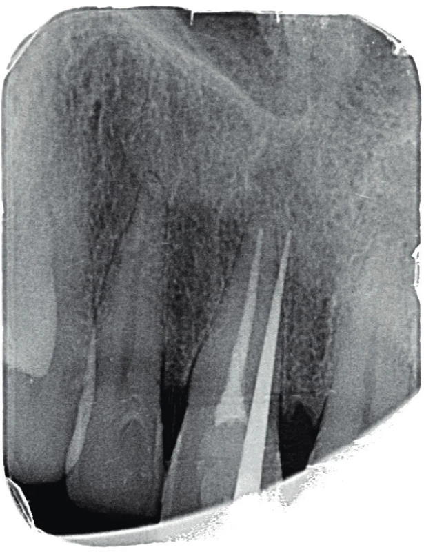 Fistulografie
horního frotálního
úseku. Zavedený
gutaperčový čep ve
fistule směřuje meziálně
od apexu
zubu 11 do místa periapikálního
projasnění