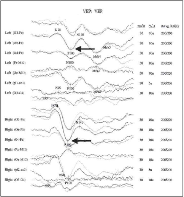 Vizuálne evokované potenciály u pacientky s potvrdenou diagnózou sclerosis
multiplex, s predlženou latenciou a poklesom amplitúdy vlny P 100 na ľavom oku.<br>
Fig. 2. Visually evoked potentials in a patient with a confi rmed diagnosis of multiple
sclerosis, with prolonged latency and decreased amplitude of P 100 wave in the left eye.