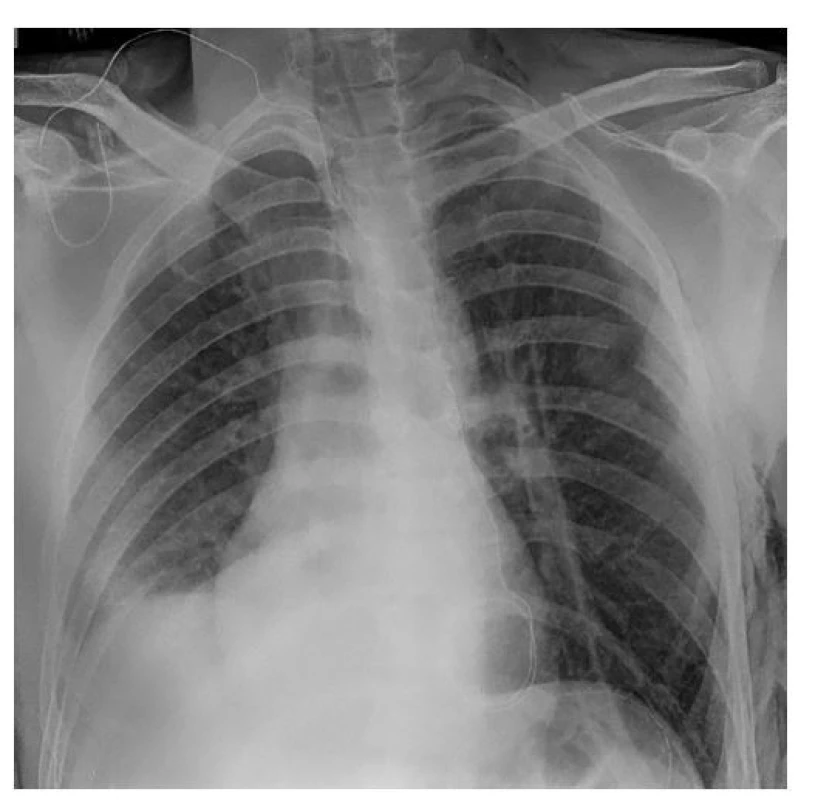 Pooperační RTG snímek<br>
Fig. 2: Postoperative X-ray scan