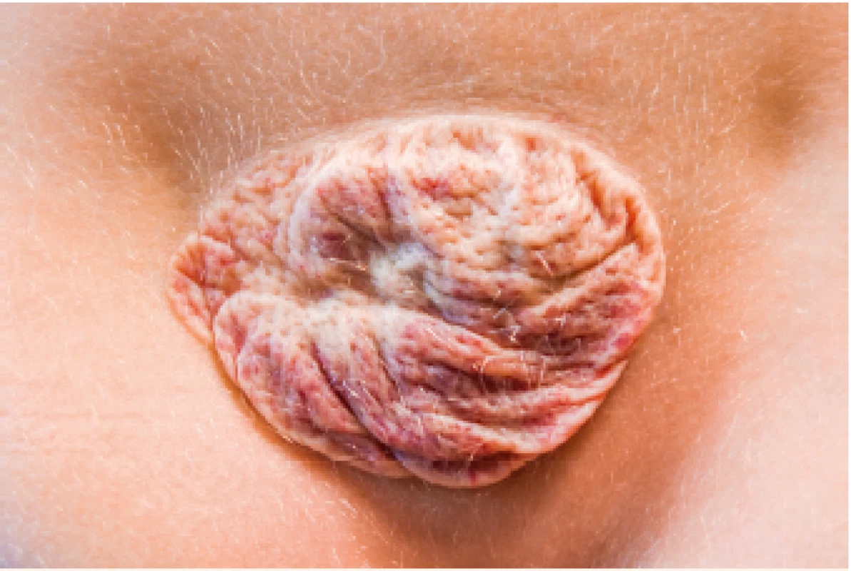 Fibrózně ztukovatělé reziduum po spontánní involuci neléčeného IH.<br>
Fibrous-fatty residuum after spontaneous IH involution without any treatment.
