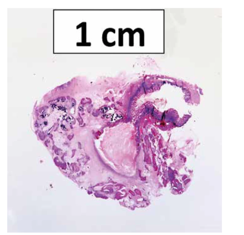 Histotopogram kalcifikovaného Meckelovho divertikula s oseálnou
metapláziou.