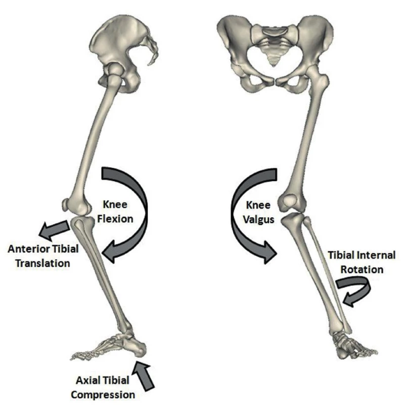 Mechanismus vzniku poranění předního zkříženého
vazu u pravého kolenního kloubu / Zdroj: Kiapour, 2013/.