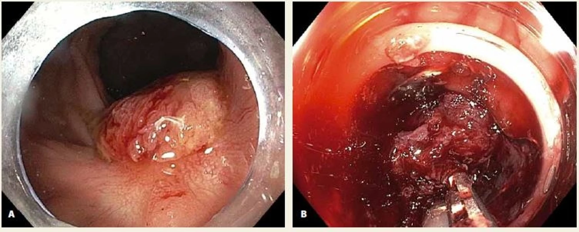 A. LRN v jizvě po EMR v rektu; B. neúspěšný pokus o vtažení fixované léze do „capu“. <br>Fig. 2. A. LRN in a post-EMR scar in the rectum; B. an unsuccessful attempt to pull the lesion into the cap.